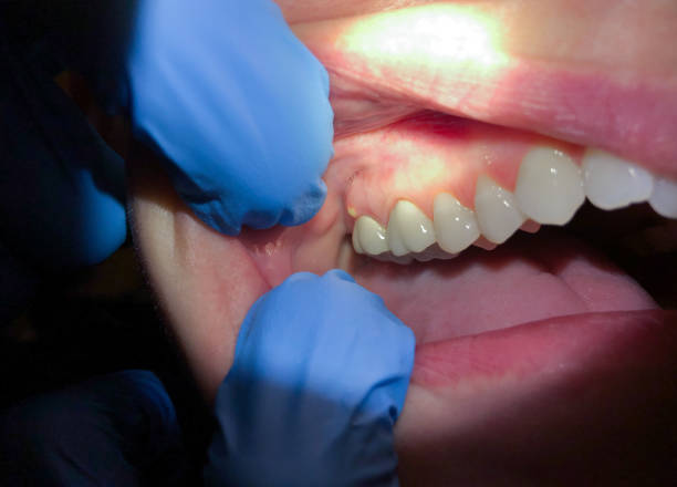 Best Emergency Tooth Extraction  in Lebanon, IN